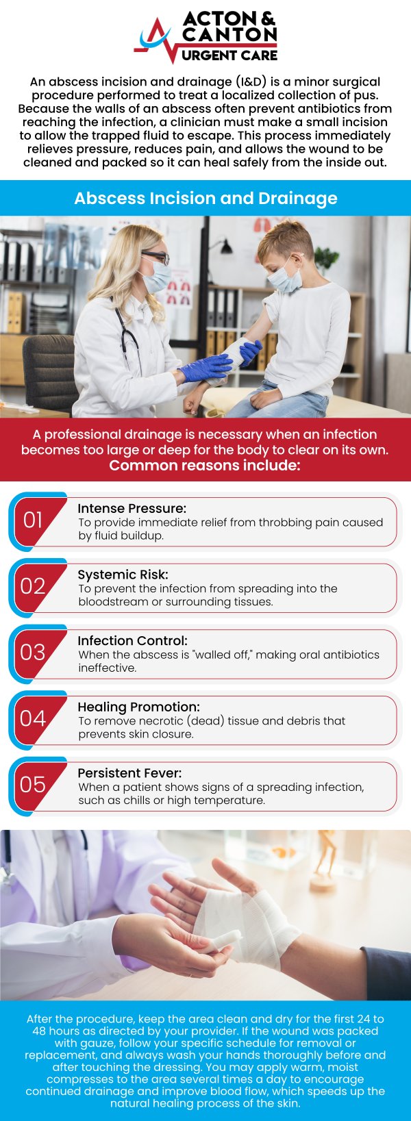 At Acton and Canton Urgent Care, Muhammad Bajwa, MD, provides prompt and effective treatment for abscesses, including incision and drainage procedures to relieve pain and prevent complications. Our skilled medical team ensures that these procedures are performed safely and efficiently, minimizing the risk of infection. For more information, contact us or schedule an appointment online. We are located at 100 Powder Mill Rd, Acton, MA 01720.