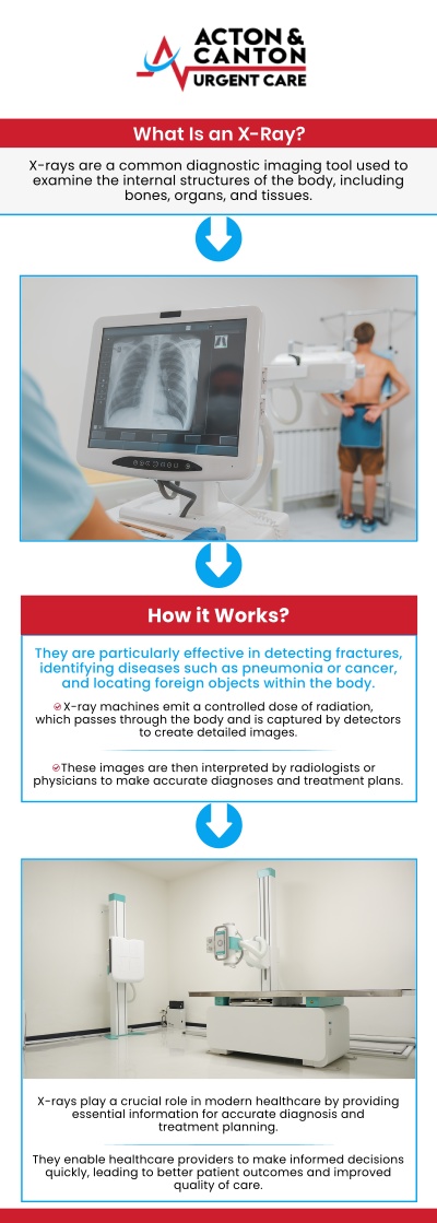 At its core, an X-ray is a quick, painless imaging test that uses a small amount of radiation to create pictures of the structures inside your body—particularly your bones. For patients at Acton Urgent Care, this technology is often the first line of defense in medical problem-solving. Our team of skilled professionals uses X-rays to see through soft tissue, capturing the dense structures beneath. For more information, contact us or schedule an appointment online. We are located at 100 Powder Mill Rd, Acton, MA 01720. At its core, an X-ray is a quick, painless imaging test that uses a small amount of radiation to create pictures of the structures inside your body—particularly your bones. For patients at Acton Urgent Care, this technology is often the first line of defense in medical problem-solving. Our team of skilled professionals uses X-rays to see through soft tissue, capturing the dense structures beneath. For more information, contact us or schedule an appointment online. We are located at 100 Powder Mill Rd, Acton, MA 01720.
